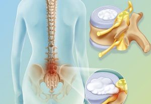 عوارض عمل دیسک کمر (بی حسی پا،عفونت، لختگی خون، درد مجدد دیسک)